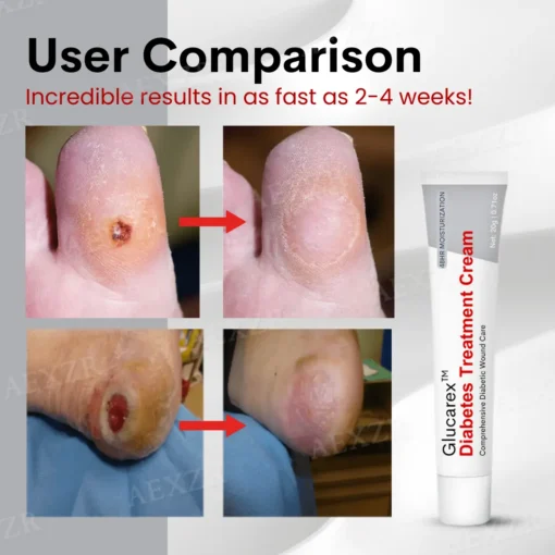 Glucarex™ Diabetes Treatment Cream