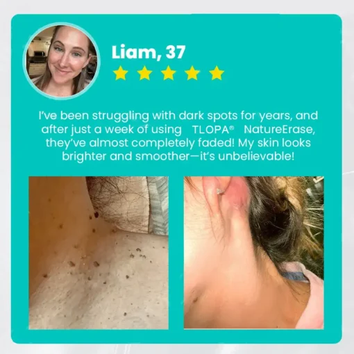 𝗧𝗟𝗢𝗣𝗔® Alligator Oil NatureErase Instant Mole & Spot Cream
