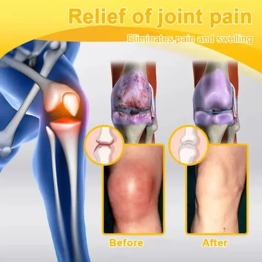 TLOPA® Botulinum Toxin & Bee Venom Pain-Relief Bone Healing Cream