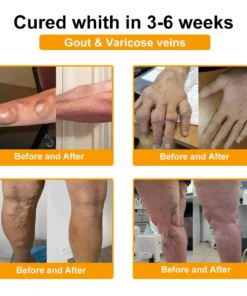 TLOPA® Botulinum Toxin & Bee Venom Pain-Relief Bone Healing Cream