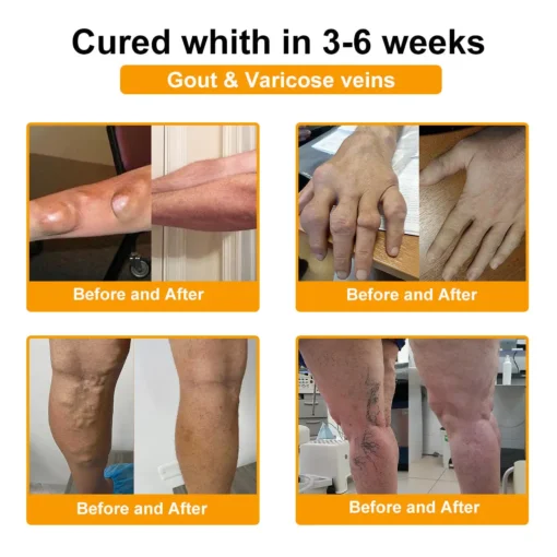 TLOPA® Botulinum Toxin & Bee Venom Pain-Relief Bone Healing Cream