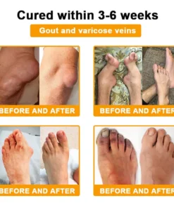 TLOPA® Botulinum Toxin & Bee Venom Pain-Relief Bone Healing Cream