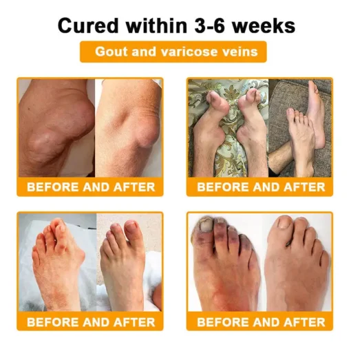 TLOPA® Botulinum Toxin & Bee Venom Pain-Relief Bone Healing Cream