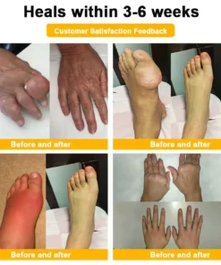 TLOPA® Botulinum Toxin & Bee Venom Pain-Relief Bone Healing Cream