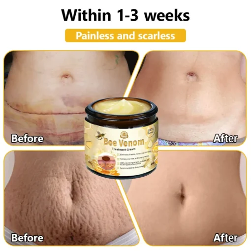 𝗧𝗟𝗢𝗣𝗔® Bee Venom Skin Treatment Cream