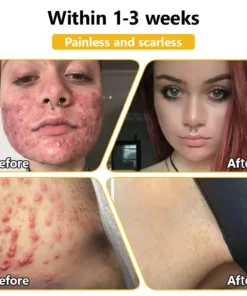 𝗧𝗟𝗢𝗣𝗔® Bee Venom Skin Treatment Cream