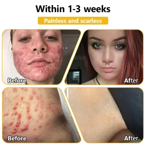 𝗧𝗟𝗢𝗣𝗔® Bee Venom Skin Treatment Cream