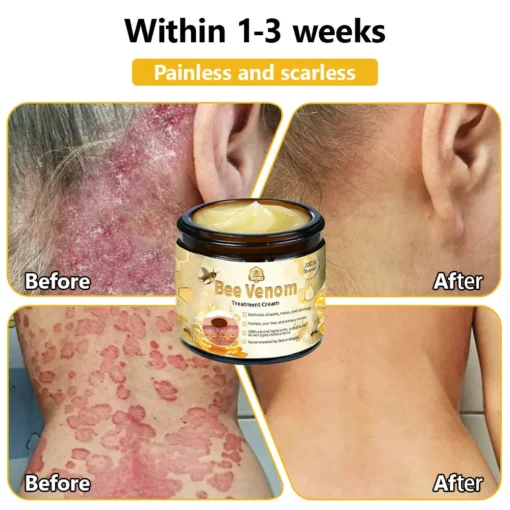 𝗧𝗟𝗢𝗣𝗔® Bee Venom Skin Treatment Cream