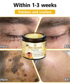 𝗧𝗟𝗢𝗣𝗔® Bee Venom Skin Treatment Cream