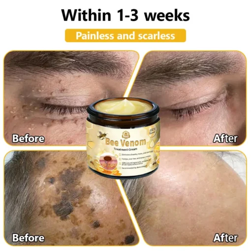 𝗧𝗟𝗢𝗣𝗔® Bee Venom Skin Treatment Cream