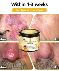 𝗧𝗟𝗢𝗣𝗔® Bee Venom Skin Treatment Cream