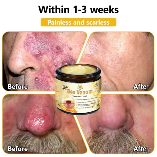𝗧𝗟𝗢𝗣𝗔® Bee Venom Skin Treatment Cream