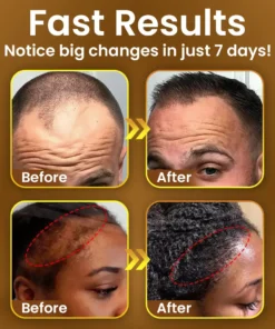 TLOPA® Hair Regrowth Capsules