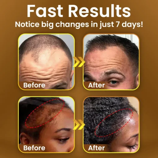 TLOPA® Hair Regrowth Capsules