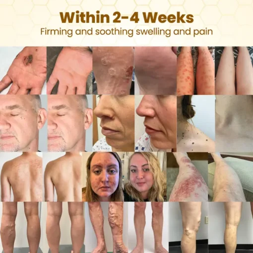 𝗧𝗟𝗢𝗣𝗔® Bee VenomSkin Restoration Cream